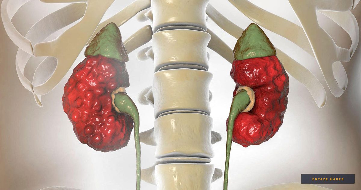 Diabetes Driving Surge in Chronic Kidney Disease Despite New Medication Breakthroughs