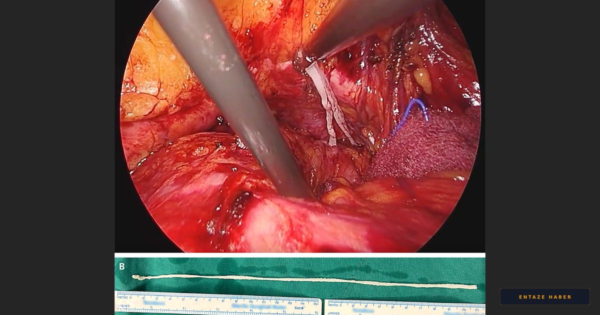 Half-Century Hitchhiker: Doctors Extract 10-Inch Tapeworm From Elderly Patient